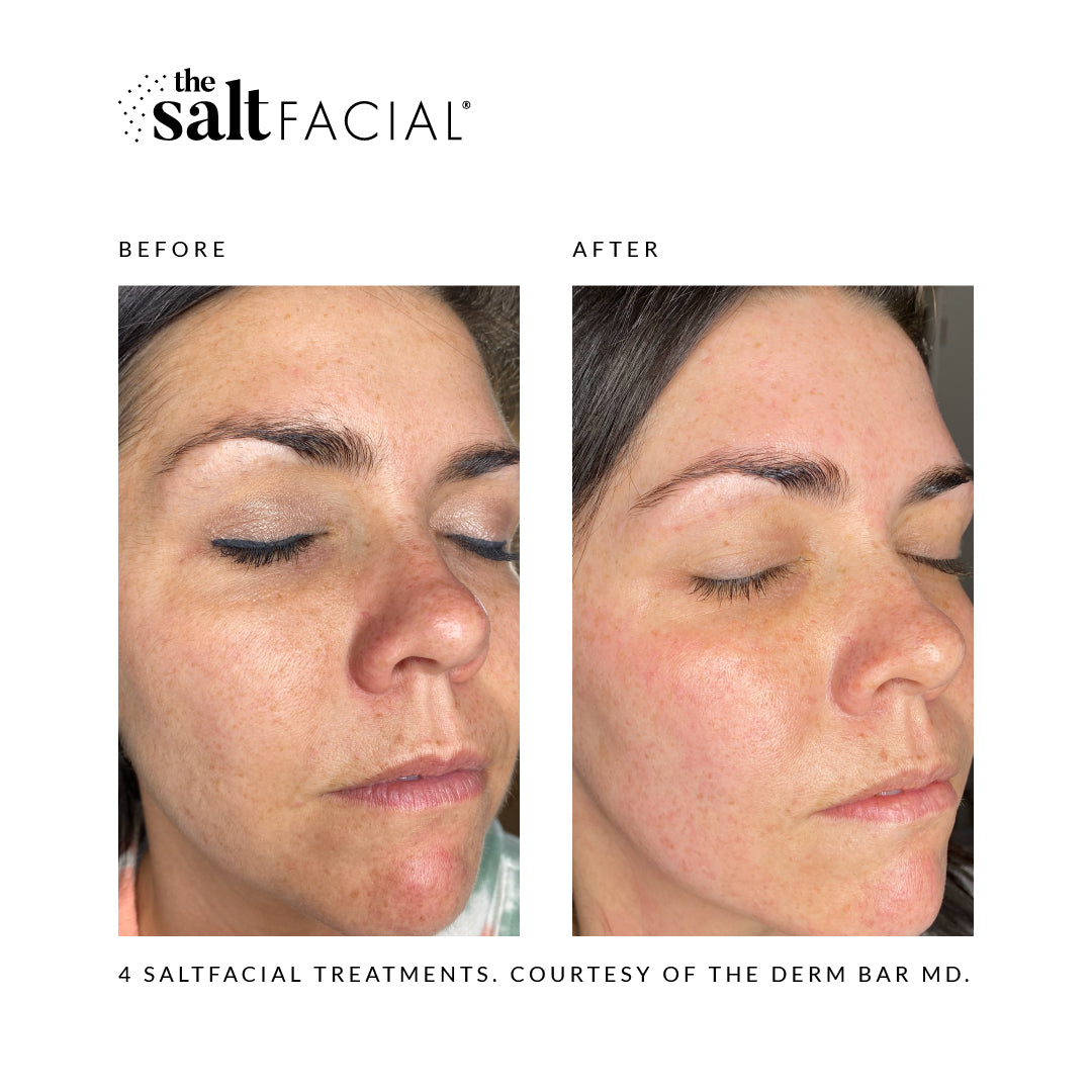 SALTFACIAL®