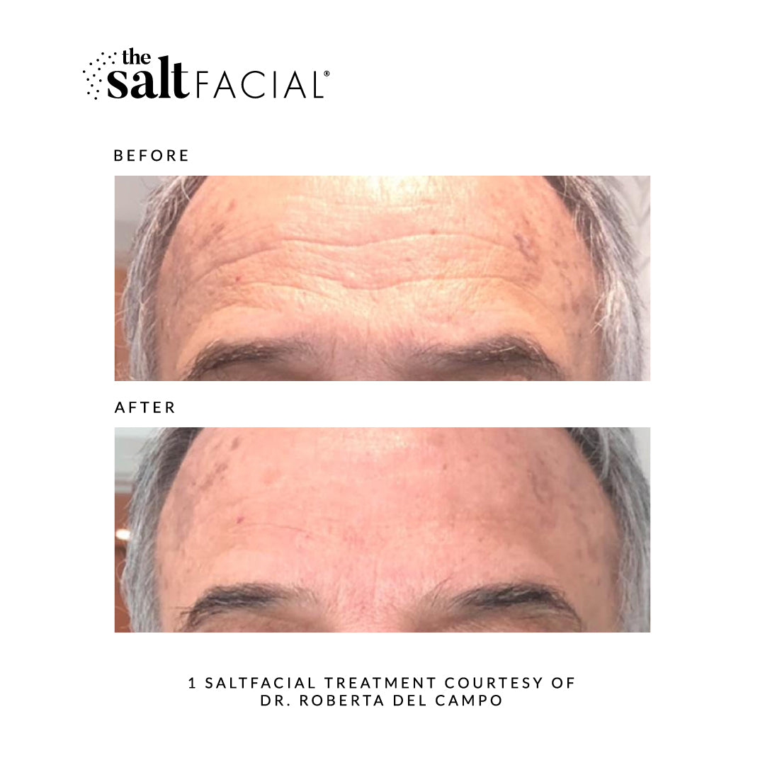 SALTFACIAL®