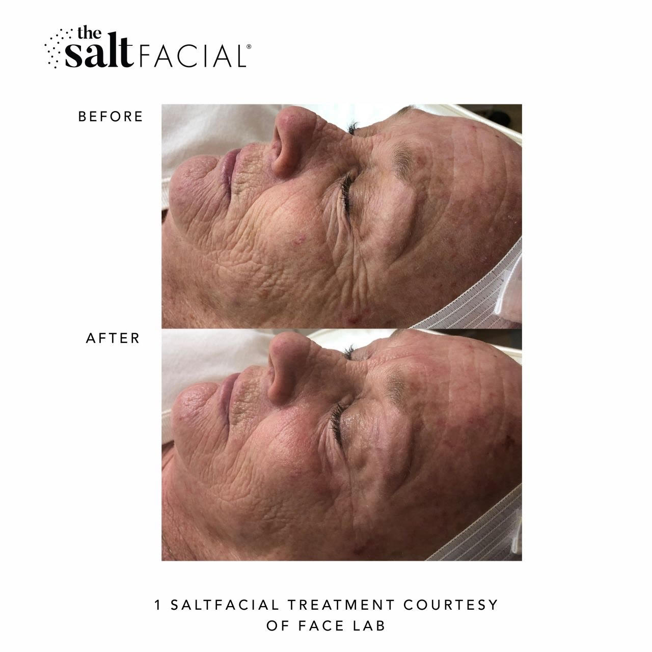 SALTFACIAL®