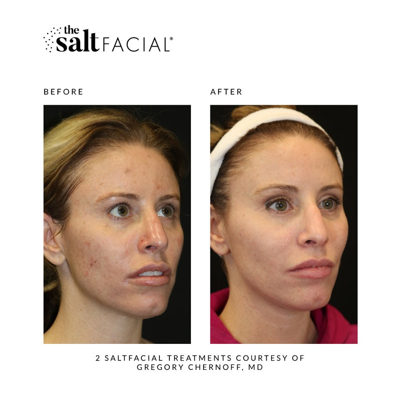 SALTFACIAL®